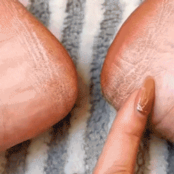 Electric Foot Callus Remover